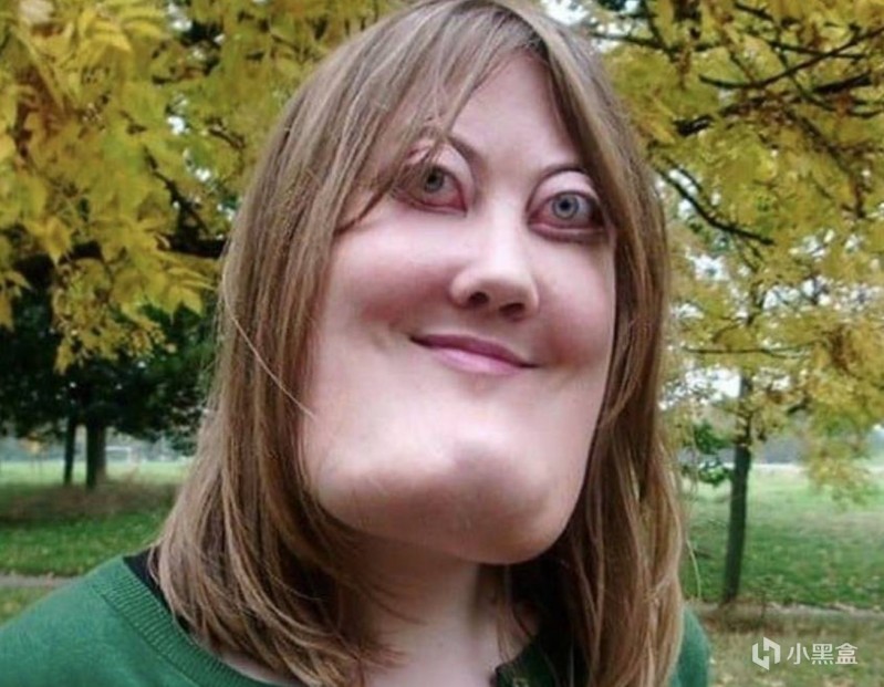 【球盟会】女子因罕见病神似《恶搞之家》角色，多年对抗外貌霸凌终发光